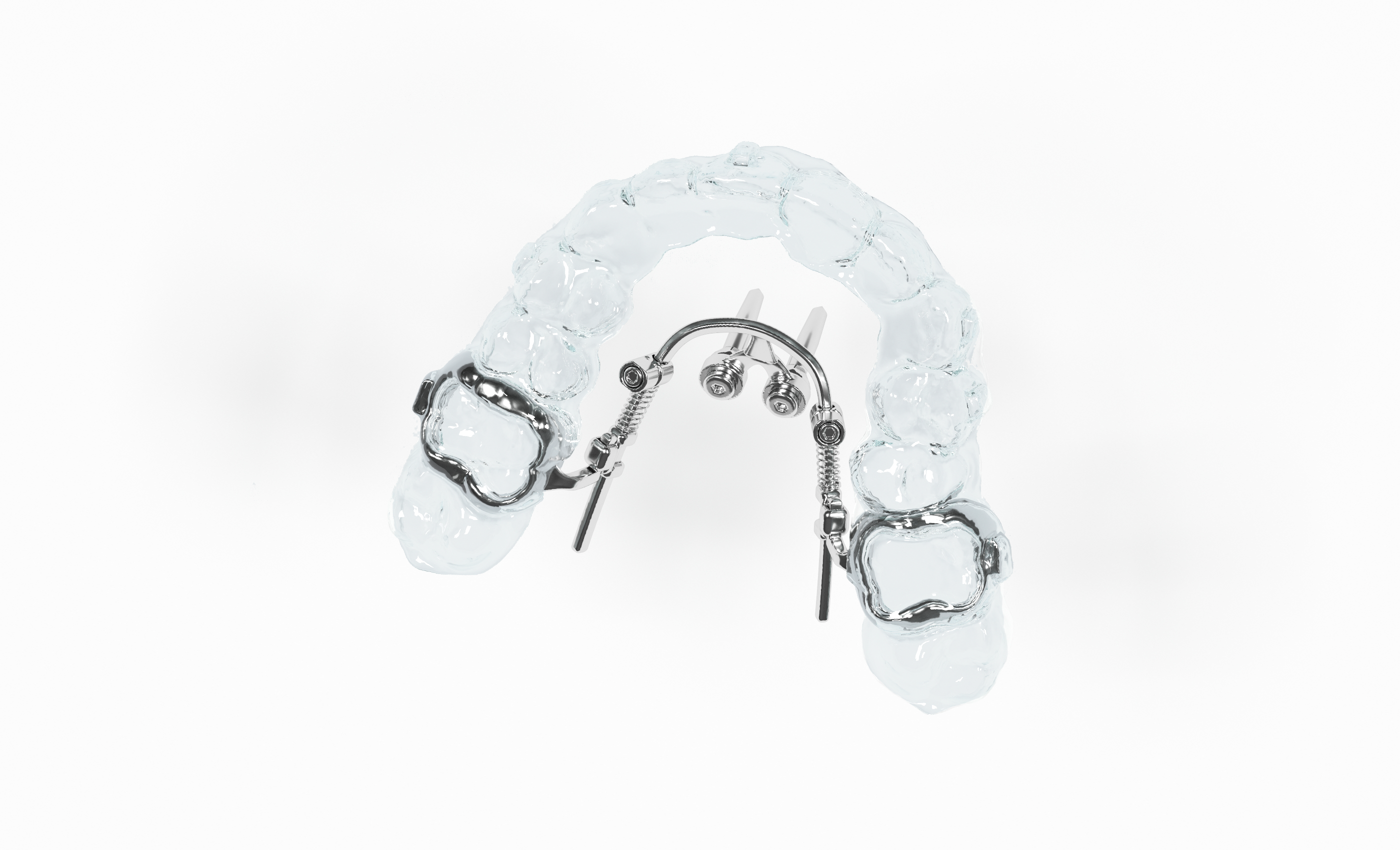 CAD CAM hybrid appliance distalization